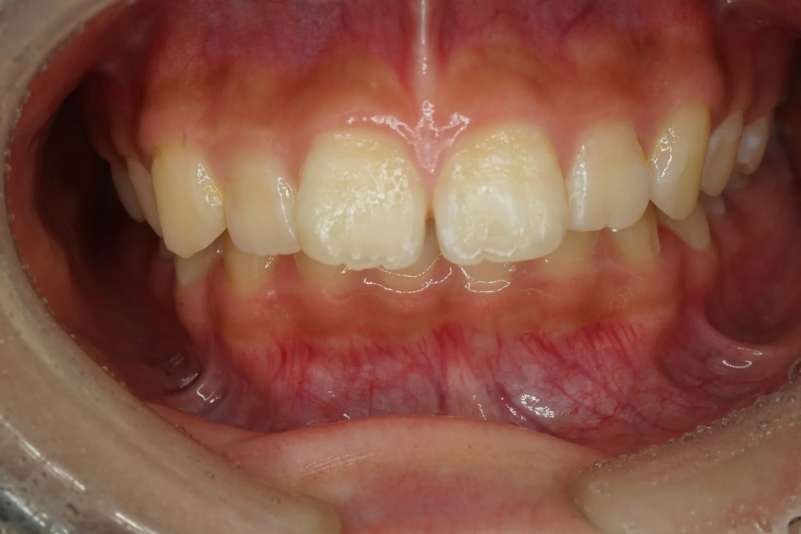 Before